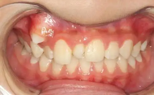 多生牙长出的位置不好应该要拔除吗