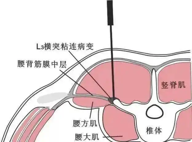 炎症,粘连,变性及增厚等,刺激腰脊神经而引起腰臀部疼痛的综合症候群