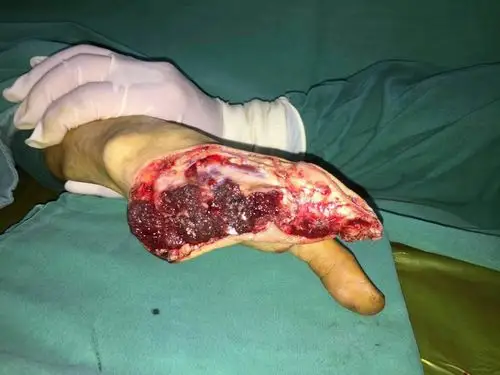 断掌成活 玉环市第二人民医院 显微外科 挽救年轻患者离断的手掌