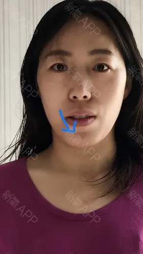 由于下方虎牙的原因,嘴角下置,两边脸不对称