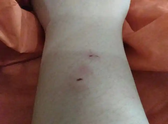 前天帮猫探热的时候被咬了一口,猫每年都有打疫苗,当时伤口一个是插进