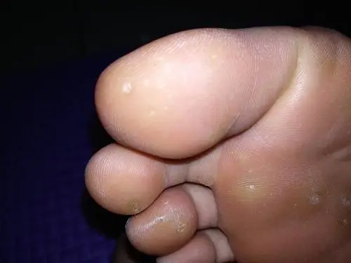 小疙瘩,硬硬的,平时不痛不痒,可是按压的话会痛,疙瘩里也没有小黑刺