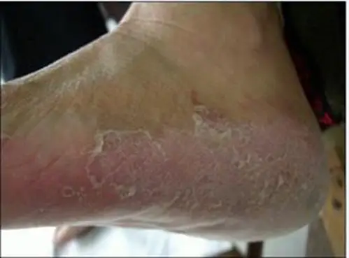 真菌性脚藓的图片