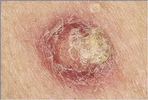 分享皮肤癌常见症状表现