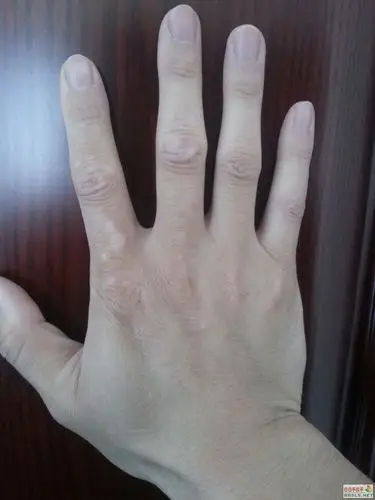 李博士您好,手背患有白癜风,求治疗方法!
