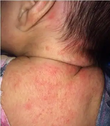 婴儿湿疹和痱子的区别图片大全