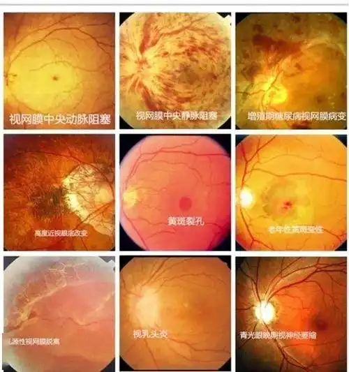 免费眼底病筛查 | 眼底一张照,眼病早知道!
