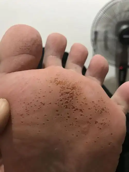 脚底长出好多小洞.  我的脚低长出好多小洞是怎么回事?