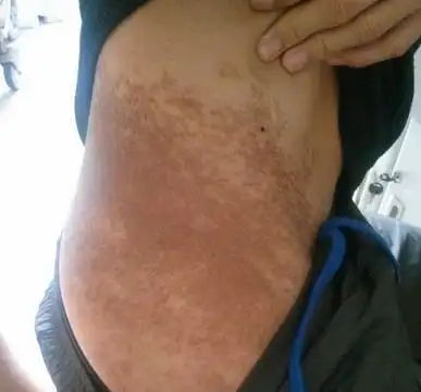 腰上的胎记意味著什麼