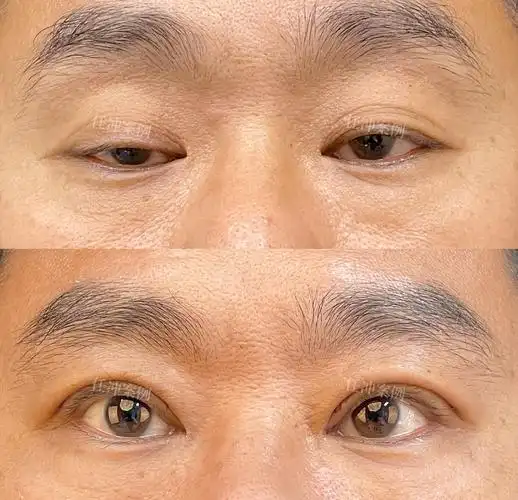 眼睛睁不开可能是上睑下垂的表现,这种情况分为真性和假性两种,改善