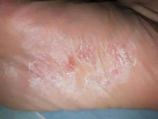 脚心瘙痒,越挠越痒,脚底挠烂了都,怎么回事?用什么药好呢?