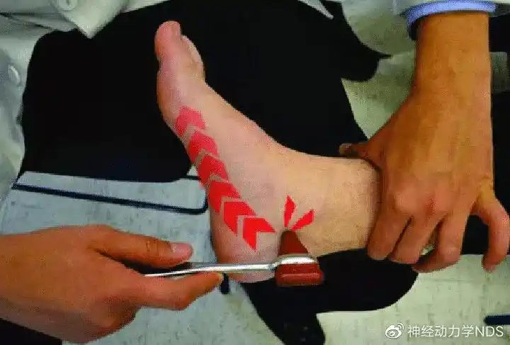 一,什么是踝管综合征