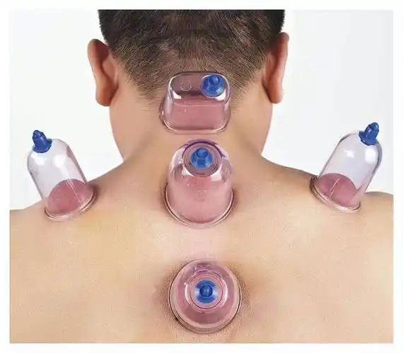 拔火罐时,后背吸出的瘀血,是排出的毒素吗?