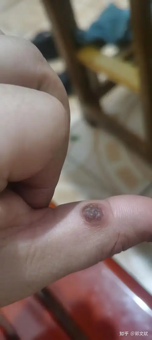 顽固瘊子终于治好了 - 知乎