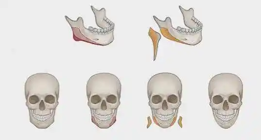 现在磨骨大概多少钱(独家揭秘) - 价格百科