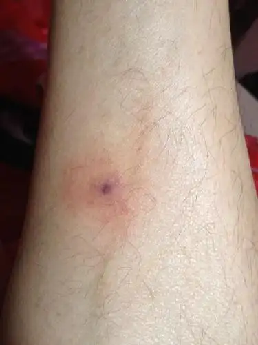 蚊子咬的包严重吗?