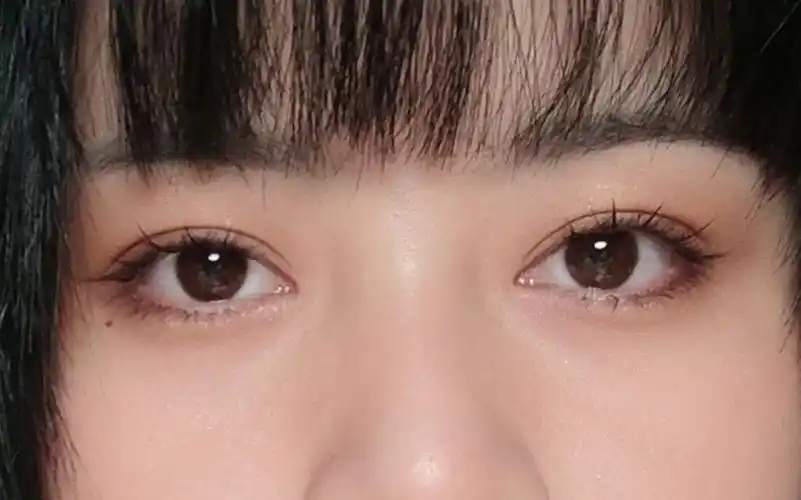 绝绝子 7mm小平行 全切双眼皮 超满意 武汉双眼皮徐逸