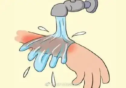 烫伤急救的五字诀