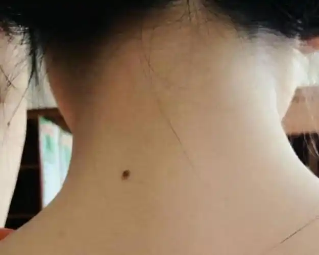 为什么有的人脖子后边有一颗痣是好是坏原来不知是巧合
