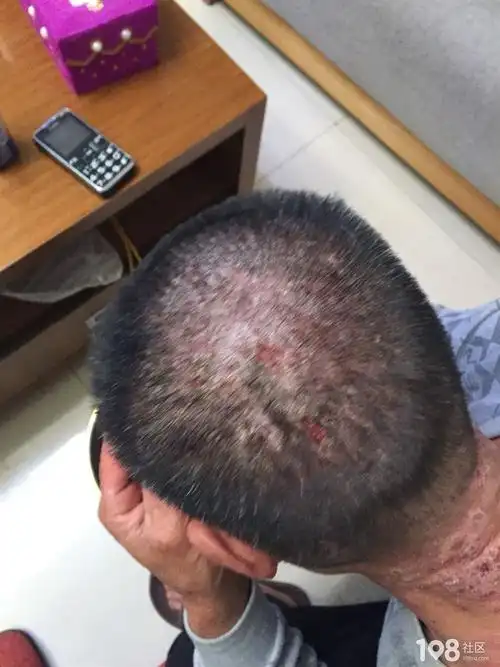 求大家帮帮我,老爸神经性皮炎反反复复好不了看到真难受