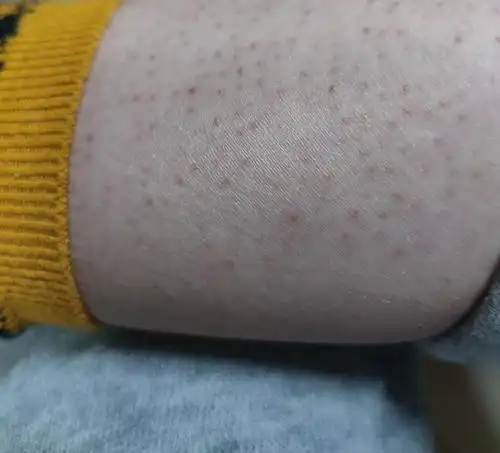 有没有毛囊角化症的姐妹