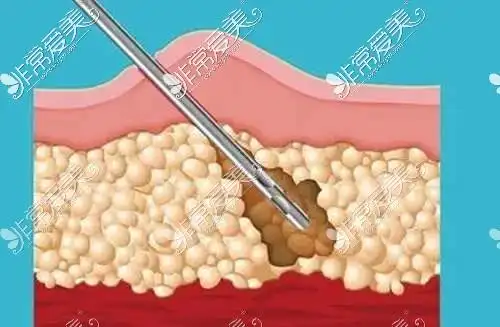 但是我却感觉还好,没有那么夸张,但是腰腹吸脂这个疼的感觉真的是忍不