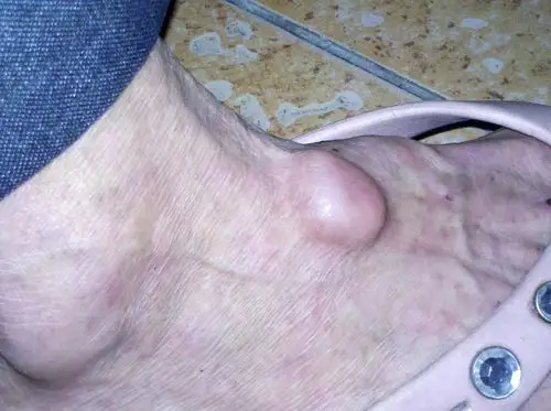 我老爸60多岁,脚背上长了一个疱,硬硬的,不疼不