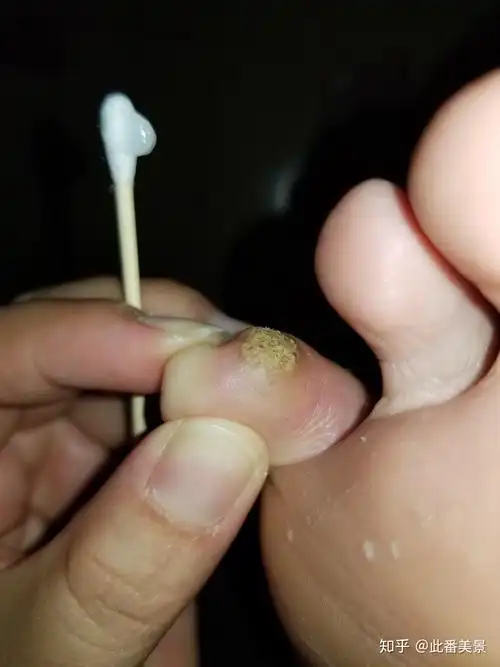 我的跖疣治疗经历(带图慎点) - 知乎