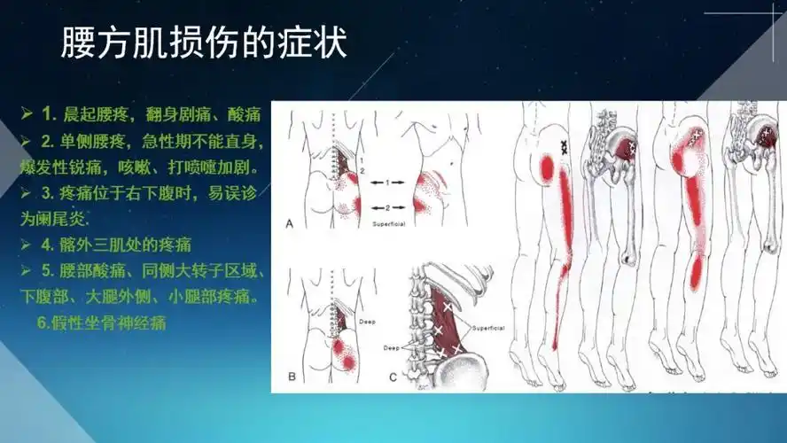 腰方肌损伤的针刀治疗思路