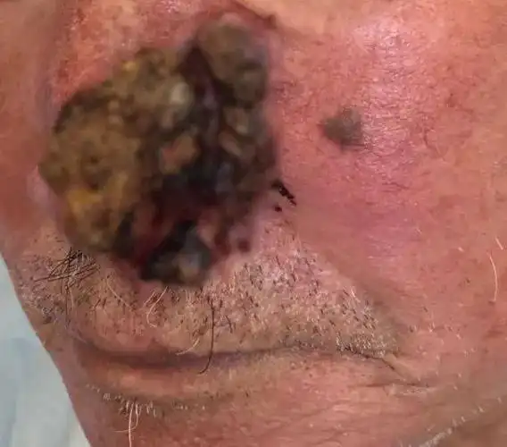 鼻子烂掉了莫慌我们来搞定