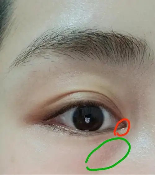 眼部脂肪粒怎么去除求助