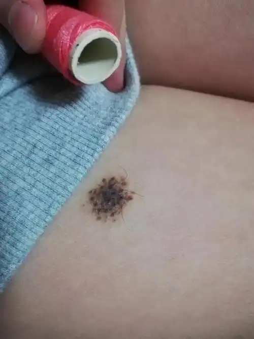 孩子腿上从出生就在腿上长了一个豆子大小的黑褐色的痣随着