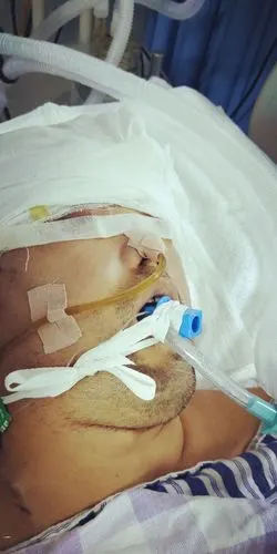 留置胃管的固定