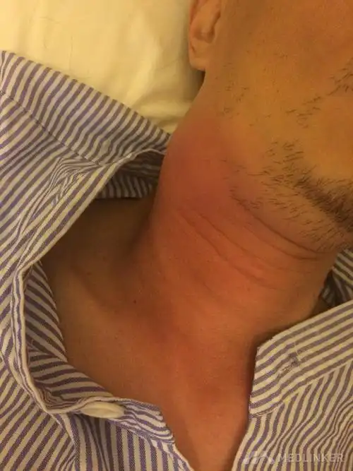 糖尿病合并颈部淋巴结肿大1例