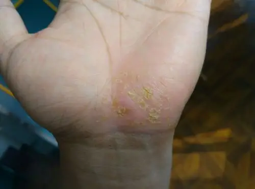 手掌湿疹牛皮整,用原始点按推温敷好转案例