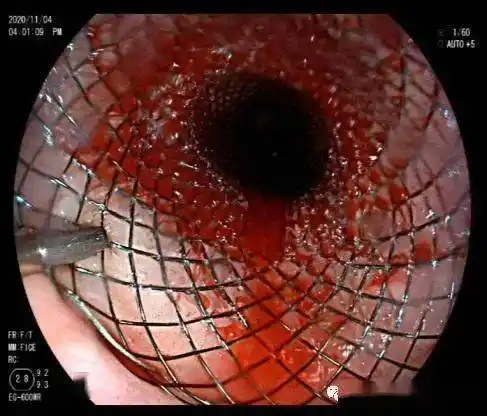 【技术新突破】我院消化内科成功开展食管支架置入术