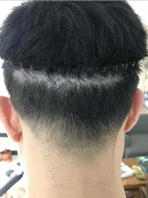 早期植发遗留在后脑勺的一条疤痕纹发有危害吗?