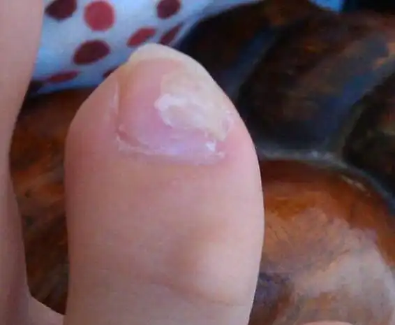 第四个脚趾甲表面裂开中间有空隙