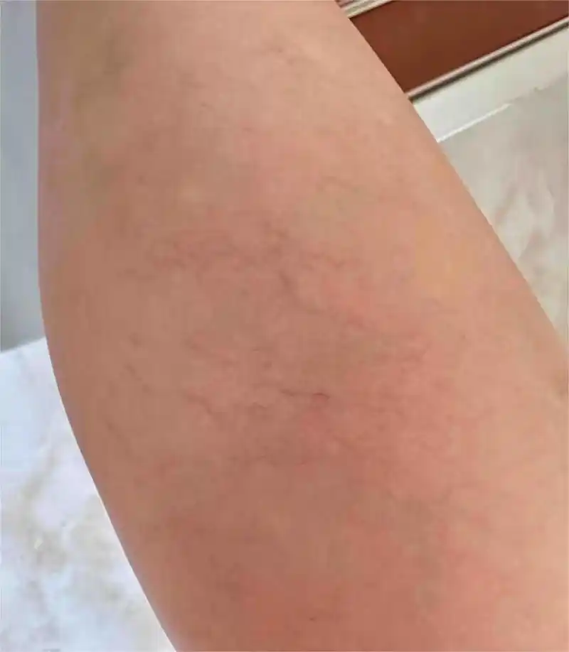 02 其实这种现象是很常见的,因为静脉曲张喜欢久站久坐的人,虽然