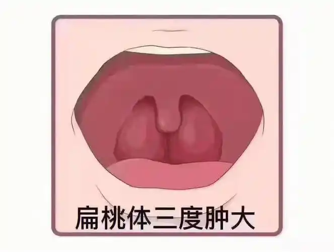 儿童扁桃体和腺样体为什么不应该手术?