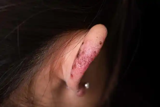 小时候长了冻疮的耳朵,长大后可能还会在同一位置复发 / 图虫创意