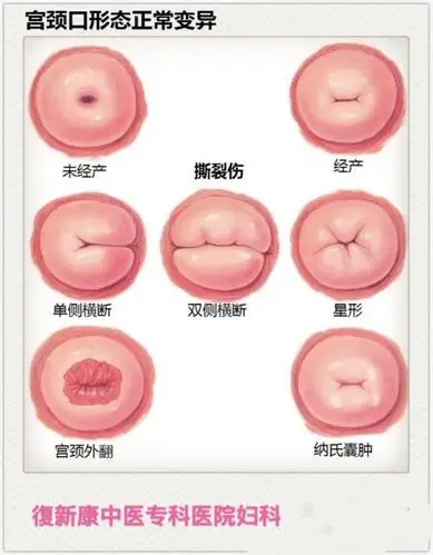 定期妇科检查,远离宫颈癌