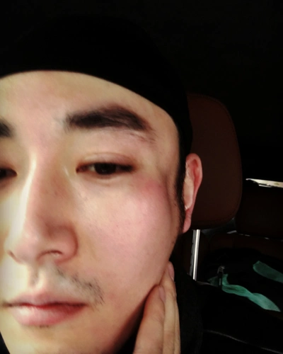 李东学原本的长相颧骨就比较高,现在颧骨骨折,骤然凹陷,看着确实令人