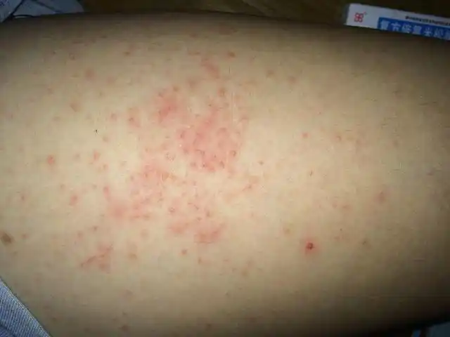 婴儿肩胛部干性湿疹是怎么引起的