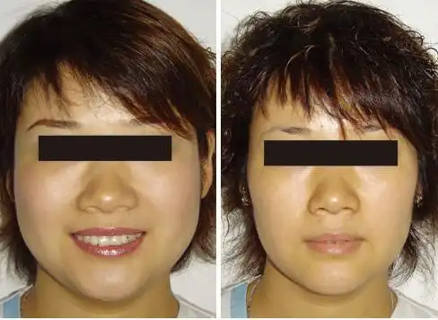 面颊部注射溶脂对比图