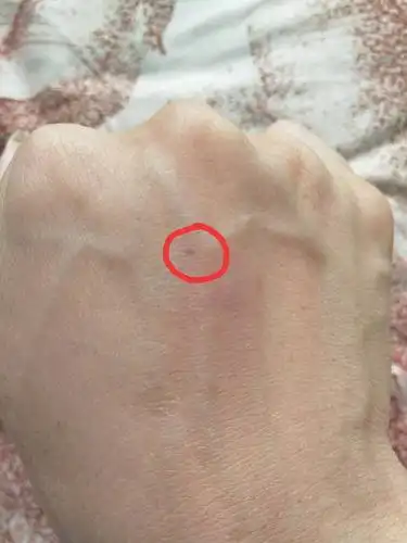 昨晚被隔壁家狗咬了一下,留下一个小印,摸上去没感觉,当时已快速用