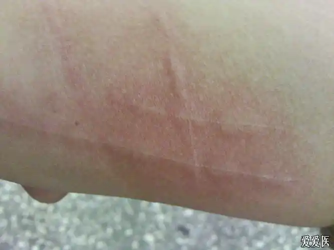 皮肤化痕症患者发作期皮试假阳性