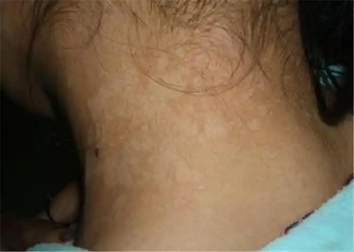 花斑癣头部脱毛症状图片