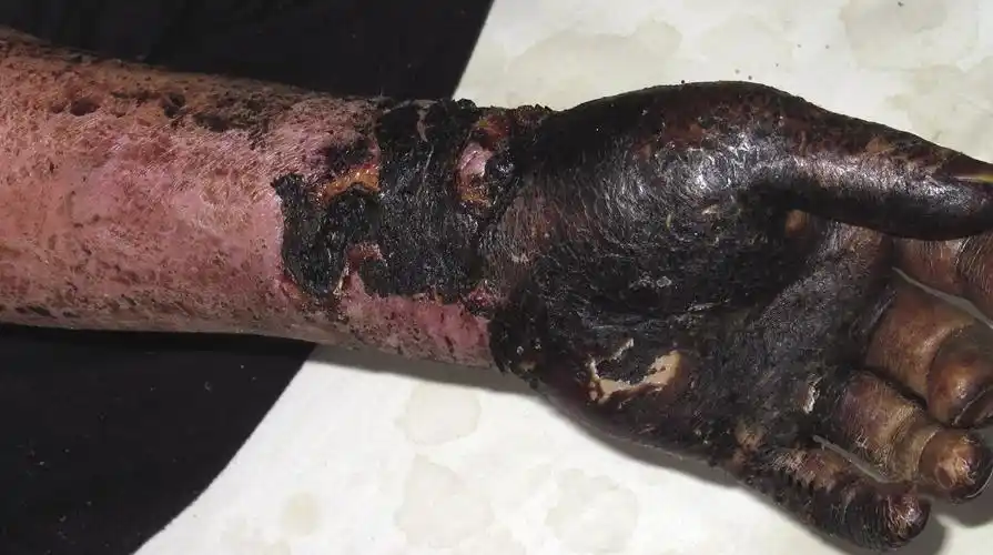 皮肤性病科图谱细菌性皮肤病炭疽