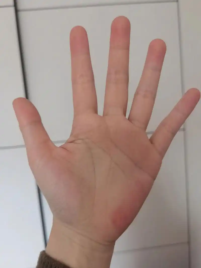 这是肝掌吗? 求解!